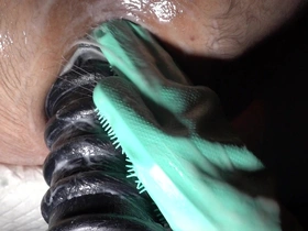 Extremely stretched anal canal